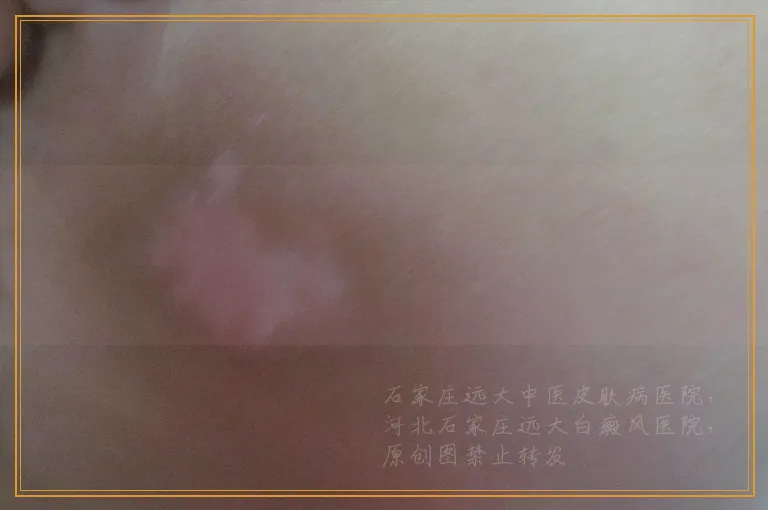 眉毛部位的白癜风照光久了会不会掉啊