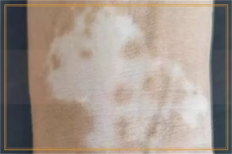 嘴唇边白斑照光后起水泡是怎么回事