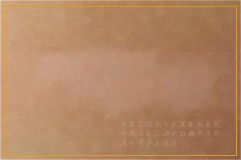 白癜风照激光的时候一般用什么辅助药