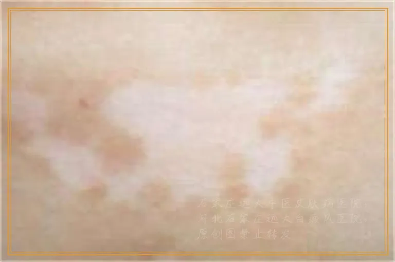 治白癜风的药都有什么