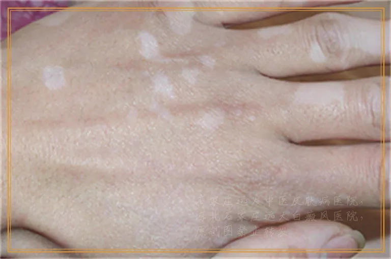 白癜风照光后白斑什么时候能变黑啊