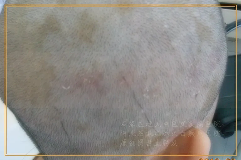 白癜风一直治疗半年了还有没有希望好