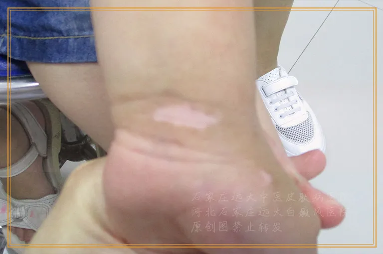 身上的白癜风2年了该怎么有效治疗