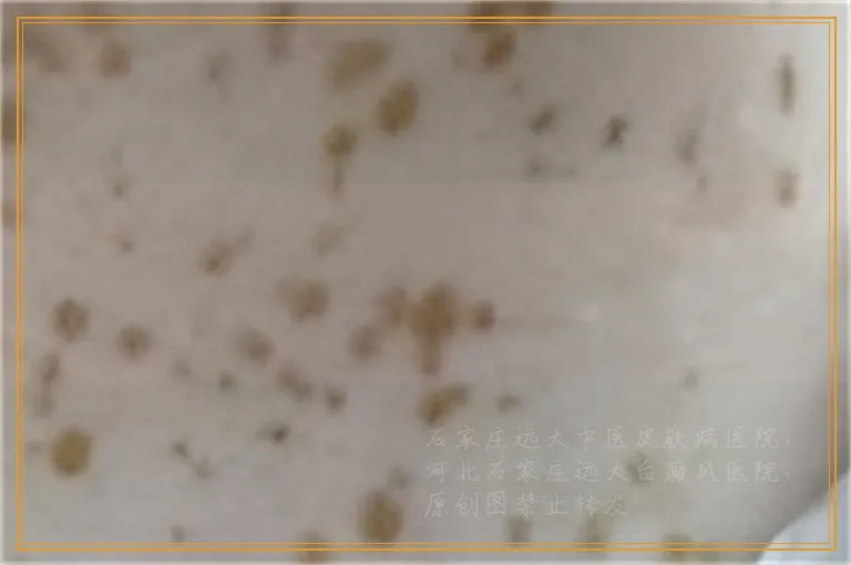 背部白癜风激光治疗没效果怎么办