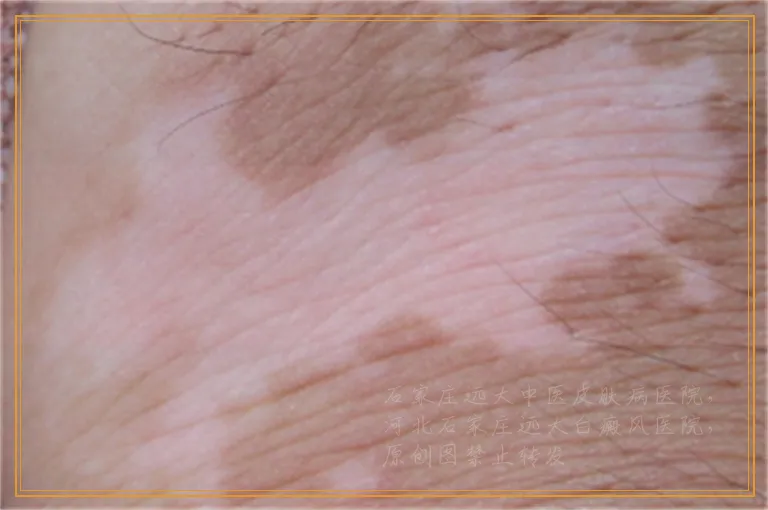 白癜风临床治疗康复率大约是多少