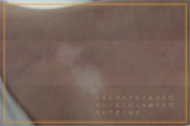 白癜风照光后显示粉红色是好现象吗