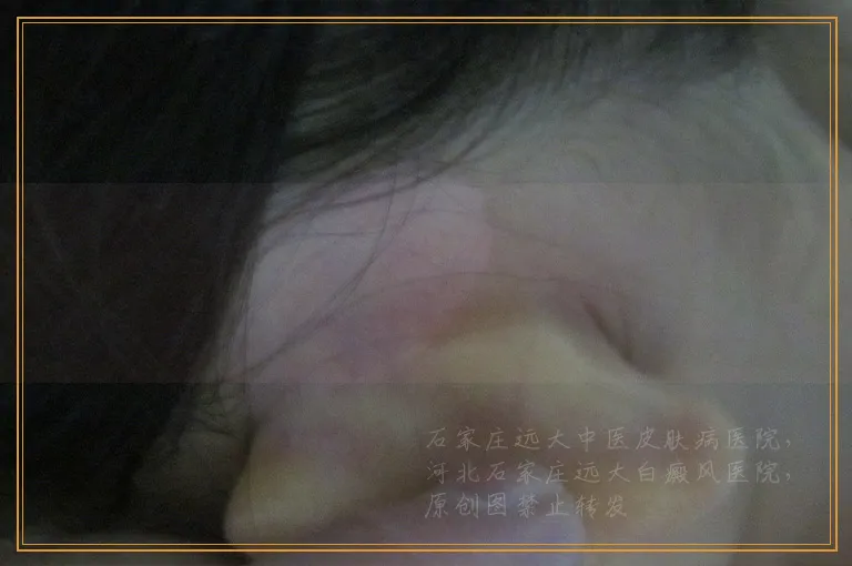 手部白癜风治疗几个疗程能好