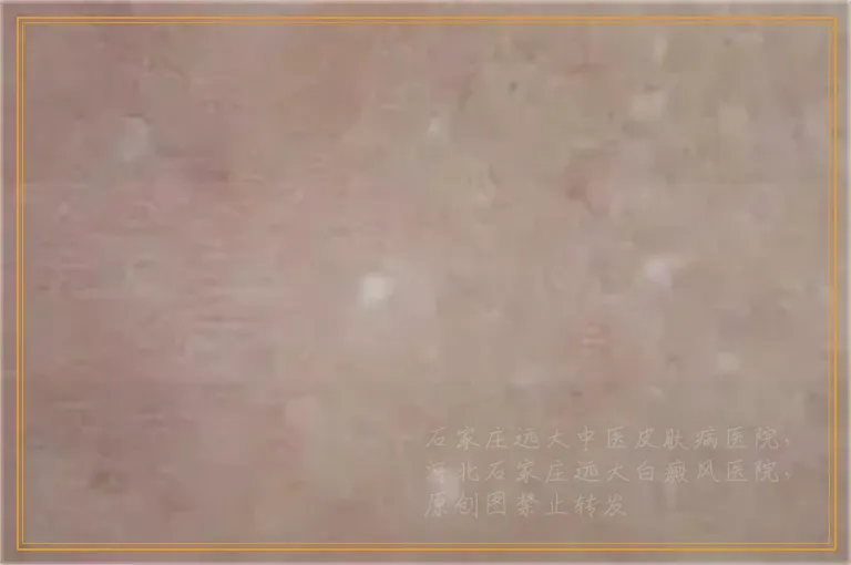 白癜风激光后起的泡泡怎么处理