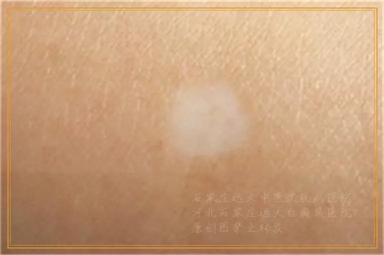 有白癜风治疗的话需要住院吗