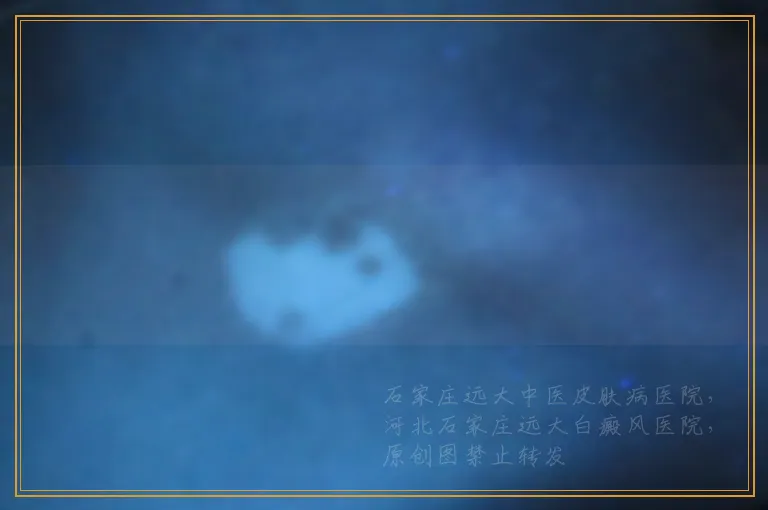 他克莫司软膏治白癜风有效果吗