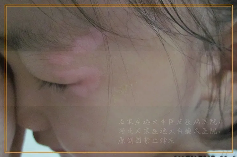 白癜风治疗三个月效果不明显怎么办