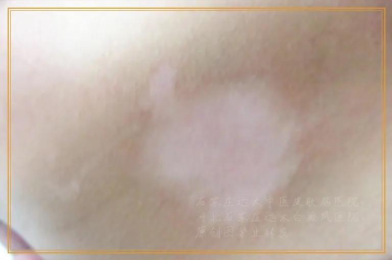 植皮治疗白癜风的价格是多少