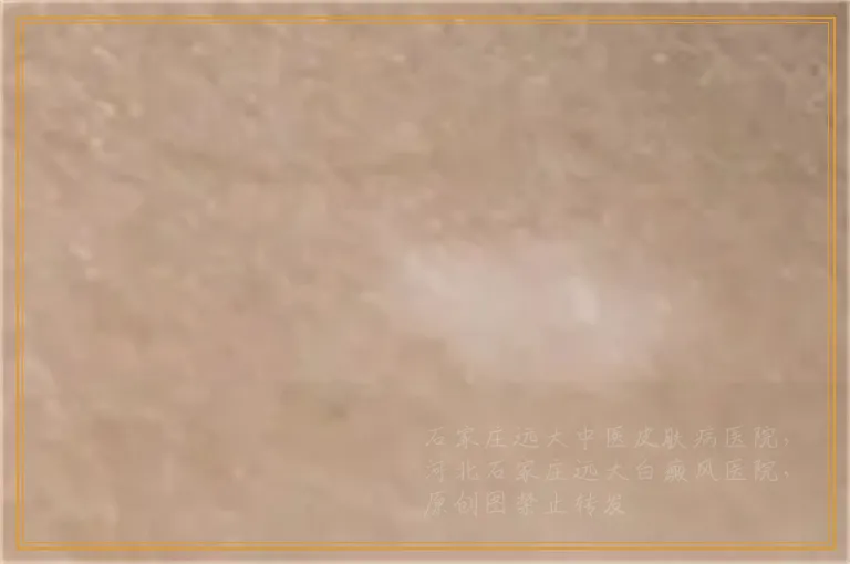 灵芝孢子粉能不能治疗白癜风