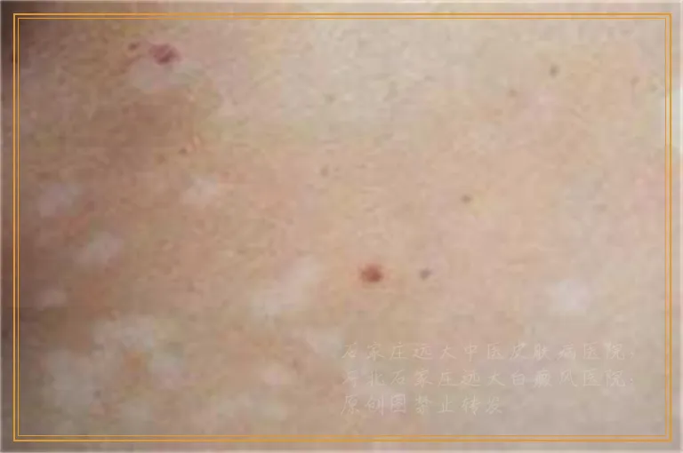 治疗白斑 为啥你们都不重视这些问题