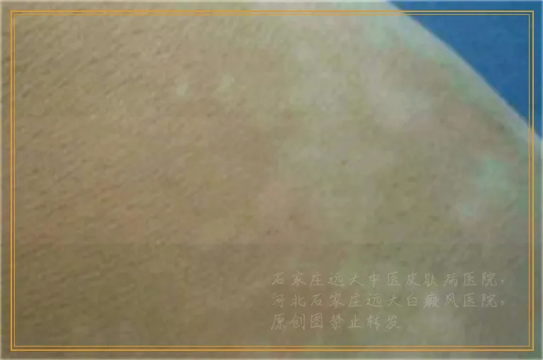 生殖器上的白癜风能抹他克莫司吗