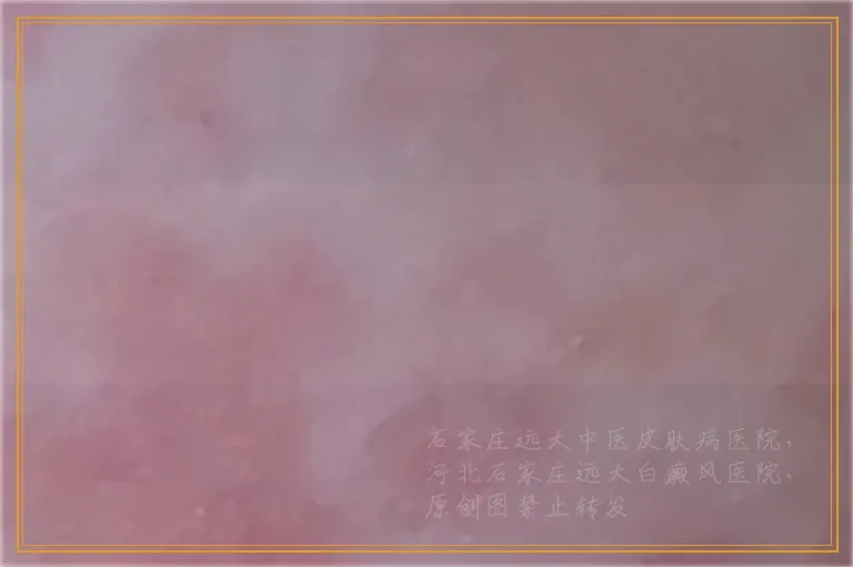 治疗复发的白癜风有什么好的办法