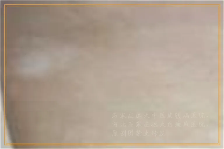 火针疗法治疗白癜风的视频