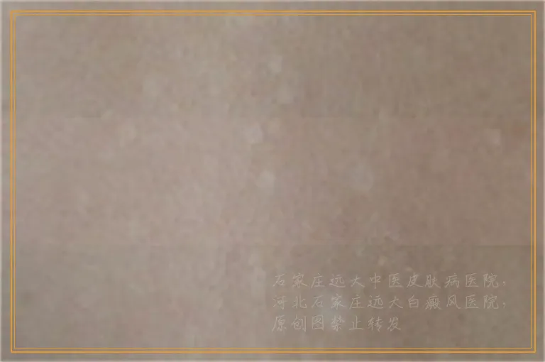 激光照白癜风后发红代表好转还是过敏