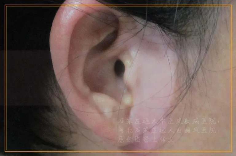 介入治疗白癜风有效果吗