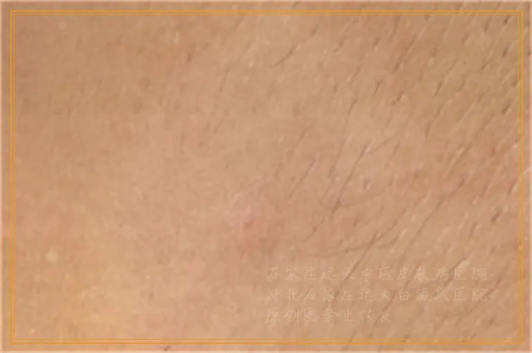 白癜风专科医院比公立的治疗效果好不好