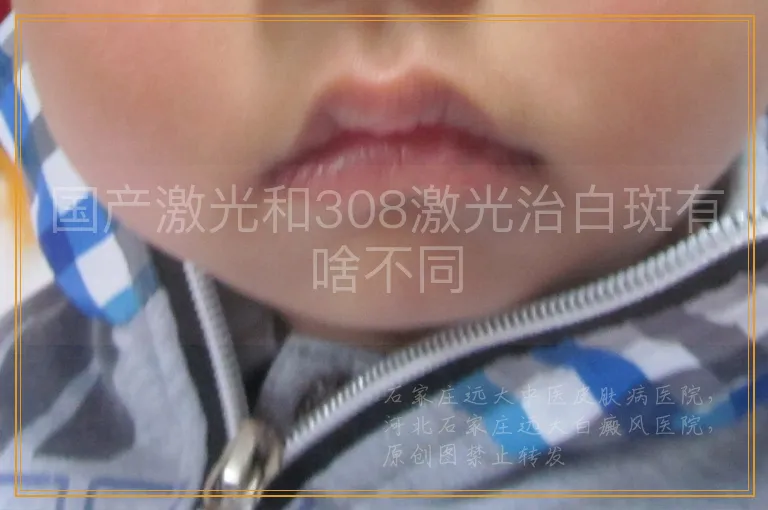 国产激光和308激光治白斑有啥不同