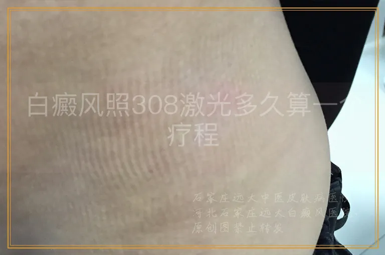 白癜风照308激光多久算一个疗程