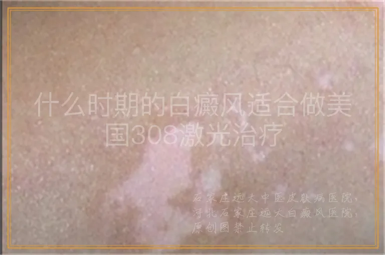 什么时期的白癜风适合做美国308激光治疗