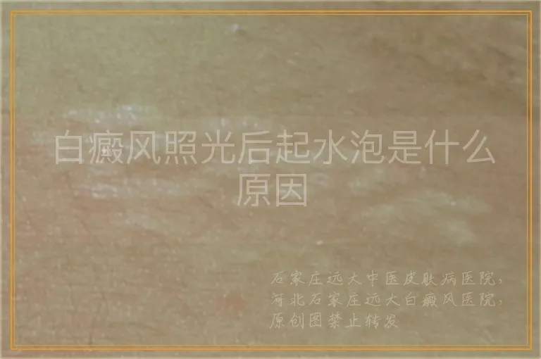 白癜风照光后起水泡是什么原因