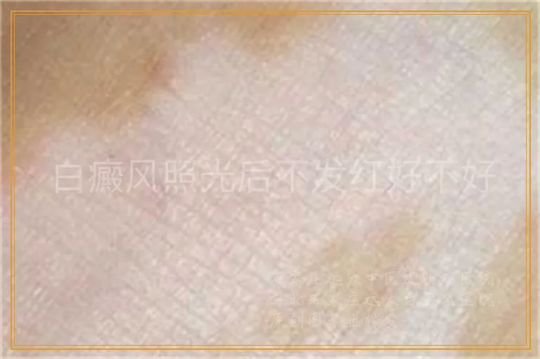 白癜风照光后不发红好不好