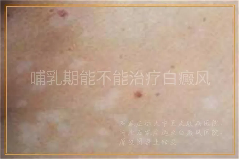 哺乳期能不能治疗白癜风