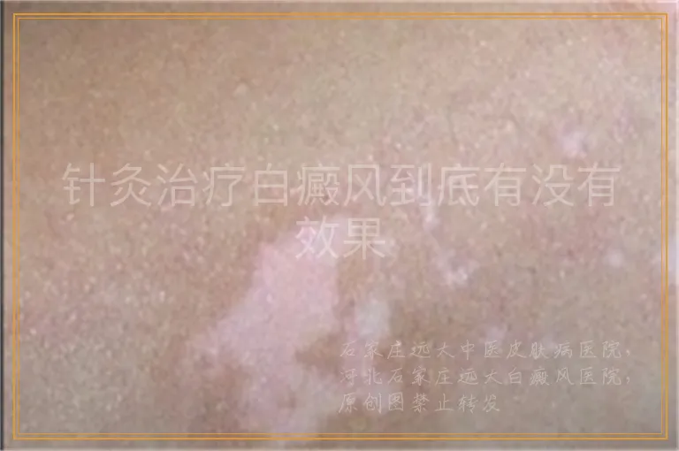 针灸治疗白癜风到底有没有效果