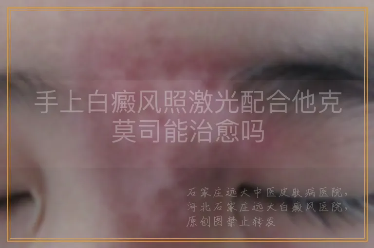 手上白癜风照激光配合他克莫司能治愈吗