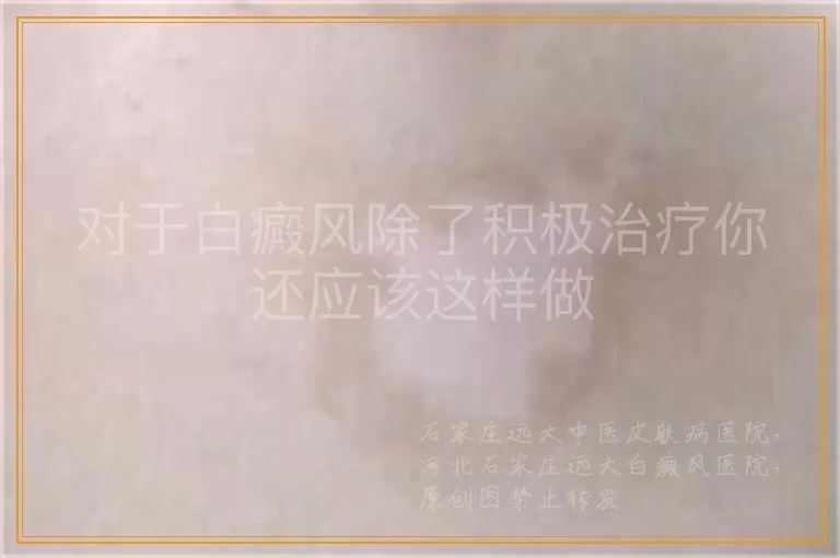 对于白癜风除了积极治疗你还应该这样做