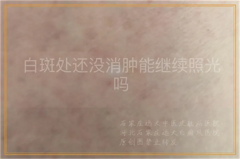 白斑处还没消肿能继续照光吗