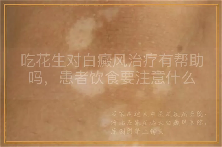吃花生对白癜风治疗有帮助吗，患者饮食要注意什么