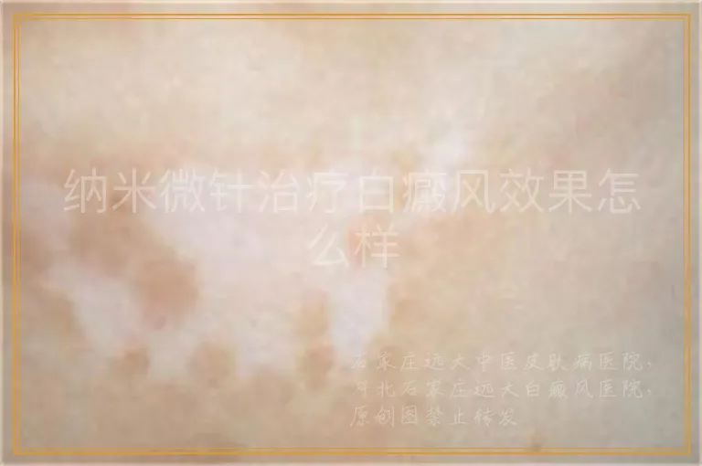 纳米微针治疗白癜风效果怎么样