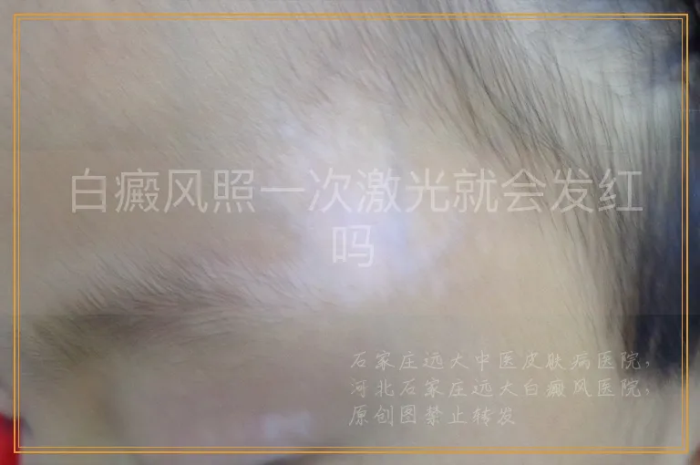 白癜风照一次激光就会发红吗