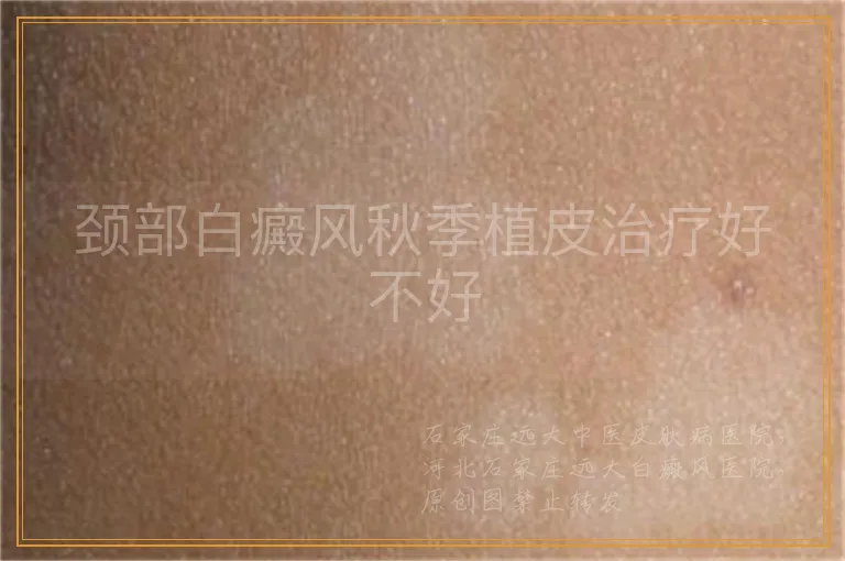 颈部白癜风秋季植皮治疗好不好