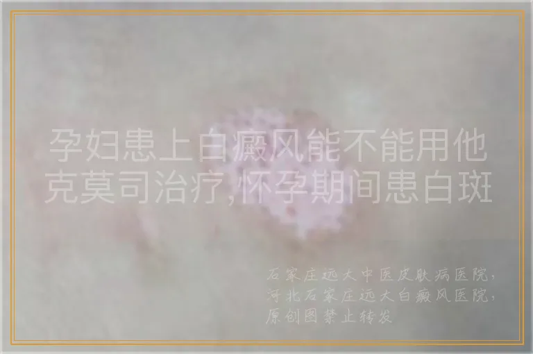 孕妇患上白癜风能不能用他克莫司治疗,怀孕期间患白斑使用他克莫司安全吗,孕期得了白癜风可以涂抹他克莫司药膏吗