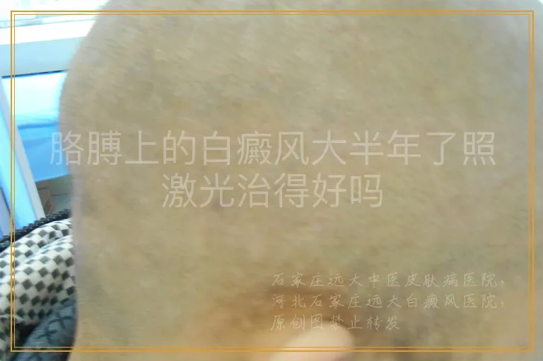 胳膊上的白癜风大半年了照激光治得好吗