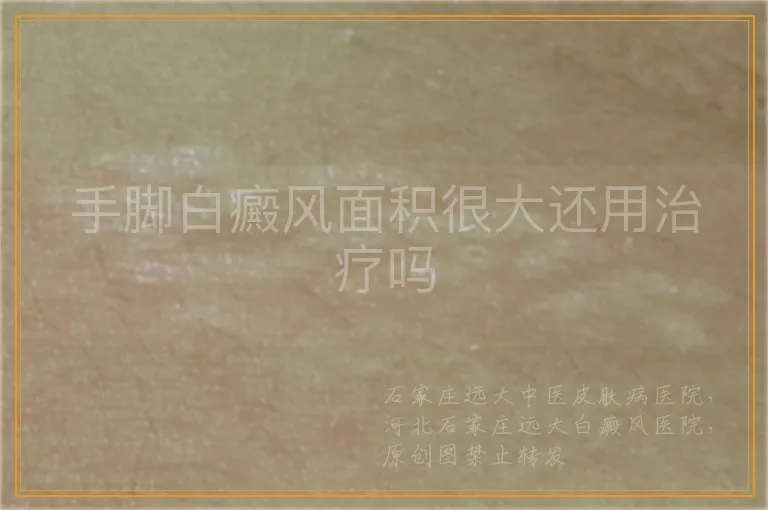 手脚白癜风面积很大还用治疗吗