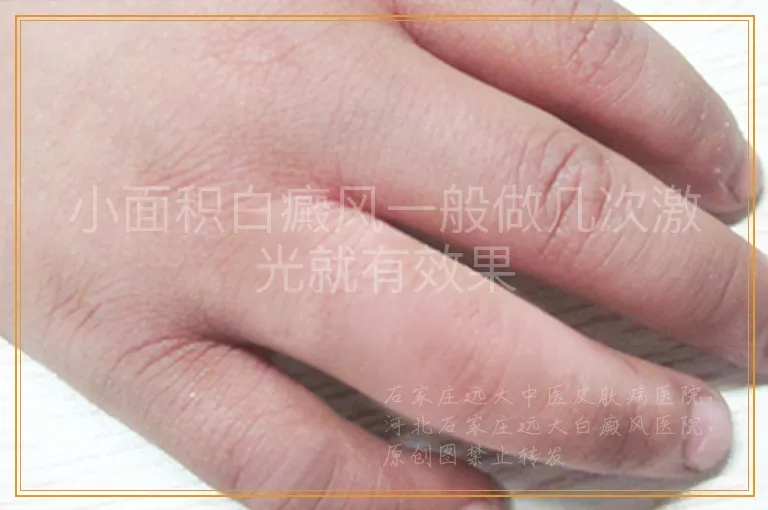 小面积白癜风一般做几次激光就有效果