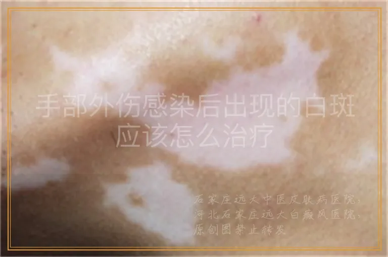 手部外伤感染后出现的白斑应该怎么治疗