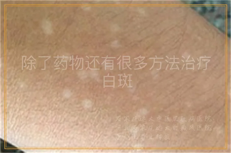 除了药物还有很多方法治疗白斑