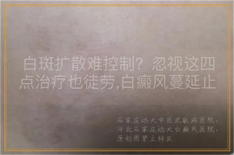 白癜风扩散了怎么控制
