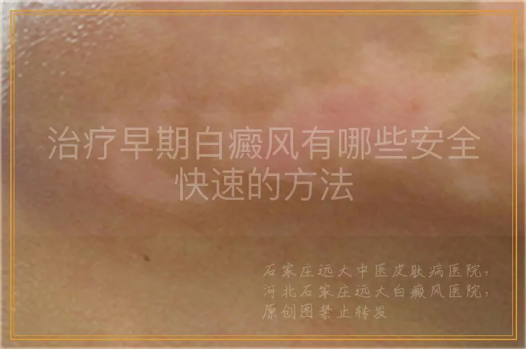 治疗早期白癜风有哪些安全快速的方法