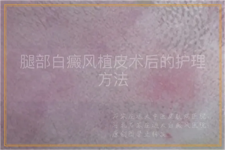 腿部白癜风植皮术后的护理方法