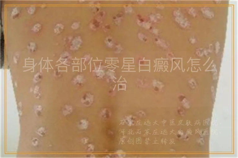 身体各部位零星白癜风怎么治