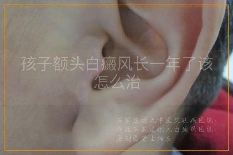 孩子额头白癜风长一年了该怎么治
