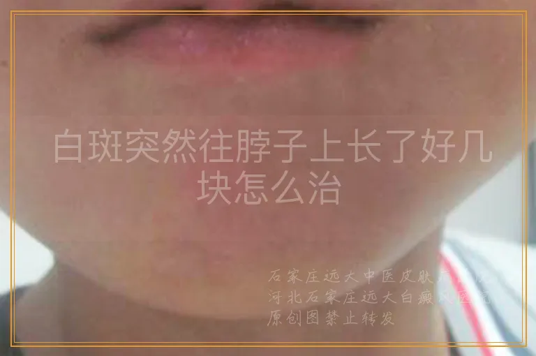 白斑突然往脖子上长了好几块怎么治